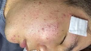 Loan Nguyen New Pimple Popping Videos